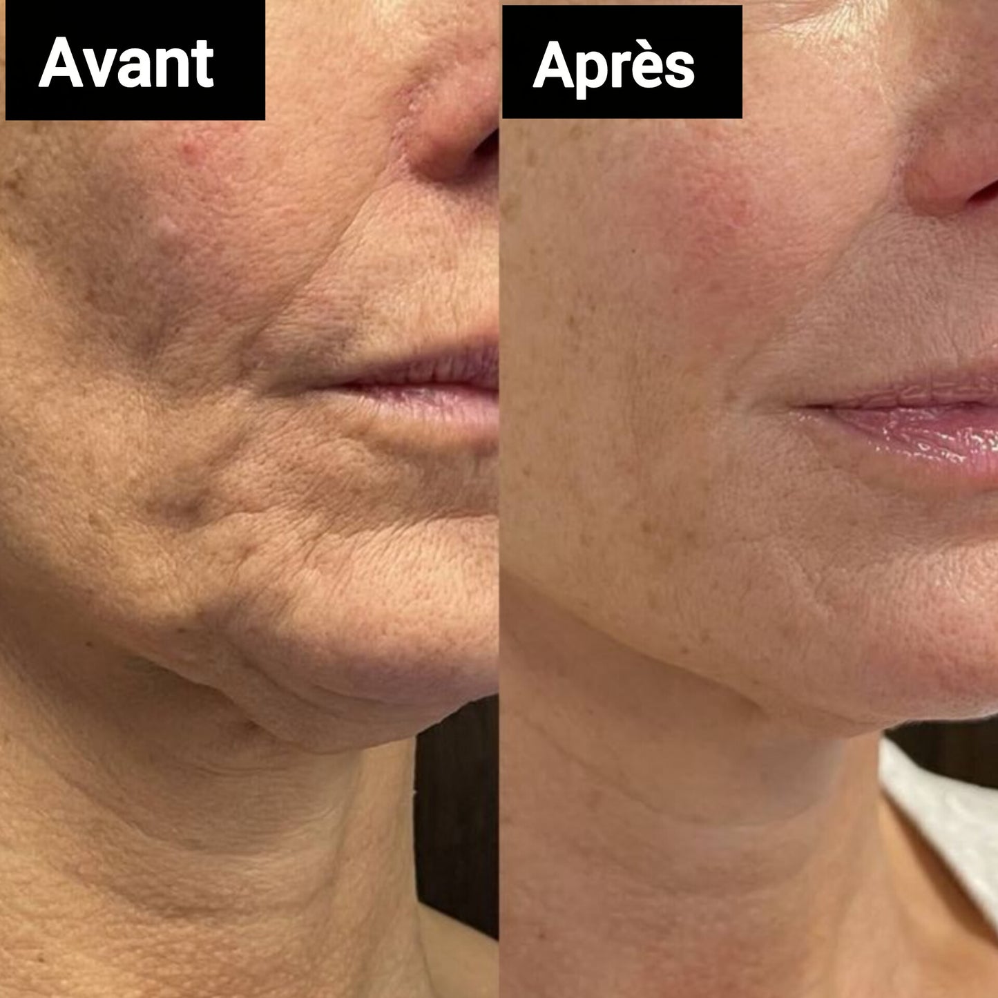 Sérum Retinol Shot Celimax – Anti-Acné